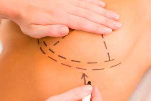 Mamas Mamoplastia - Porto Alegre - Dr. Marcelo Citrin